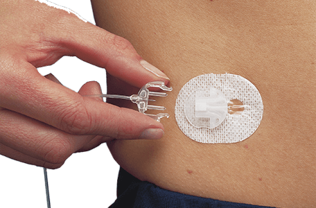 minimed-silhouetter_infusion_500x300